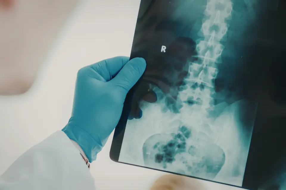 Spine Arthritis: Symptoms and Management