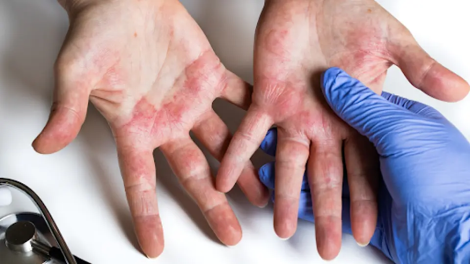 Eczema Rash Pictures: What to Look For