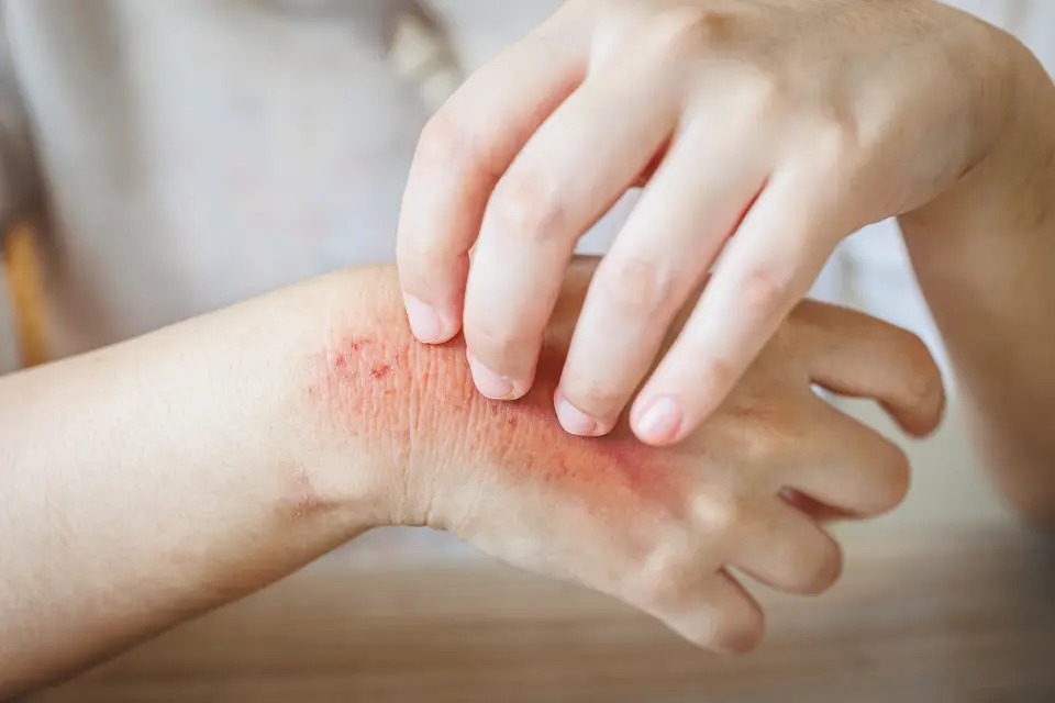 Protopic Side Effects: Common and Serious Reactions Explained