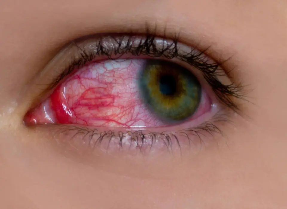 How to Care for a Broken Blood Vessel in the Eye (Subconjunctival Hemorrhage)