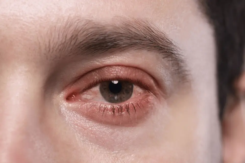 Can Telehealth Help With Pink Eye? How to Get Treatment Online