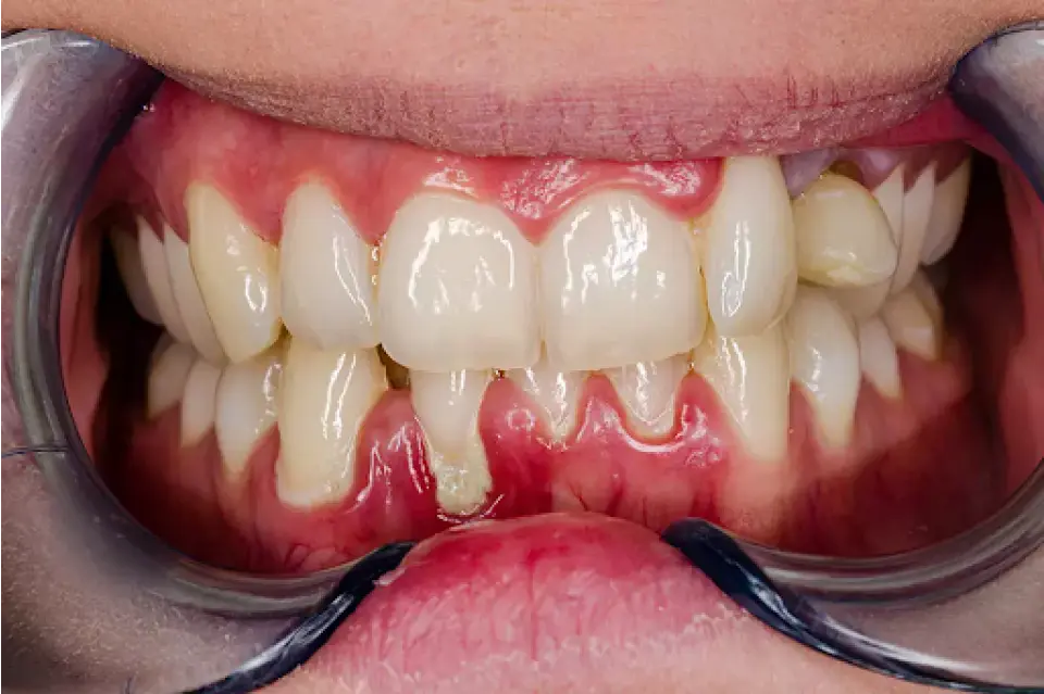 How to Cure Gingivitis in Just One Week
