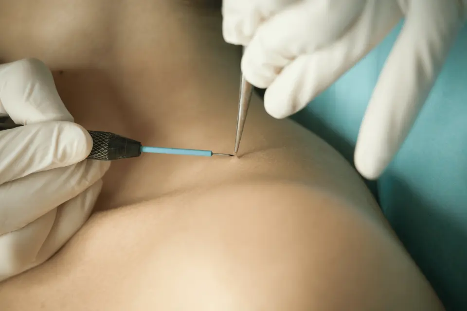 How to Get Rid of Skin Tags Safely: Home vs. Professional Methods