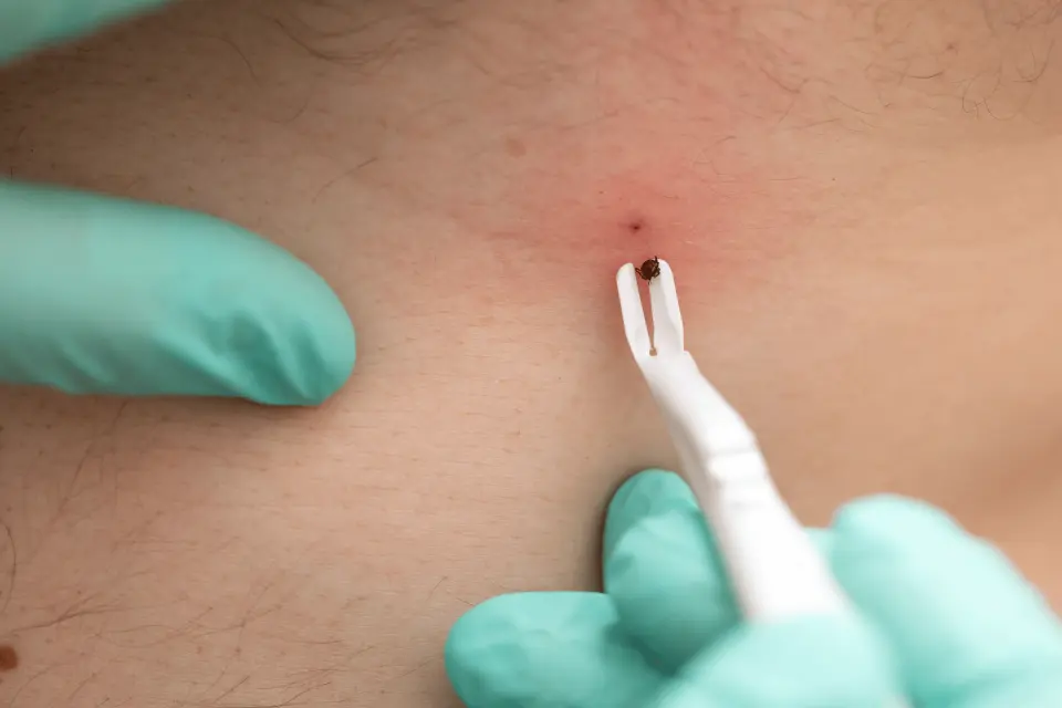 Tick Bite First Aid: Do You Need Antibiotic Ointment?