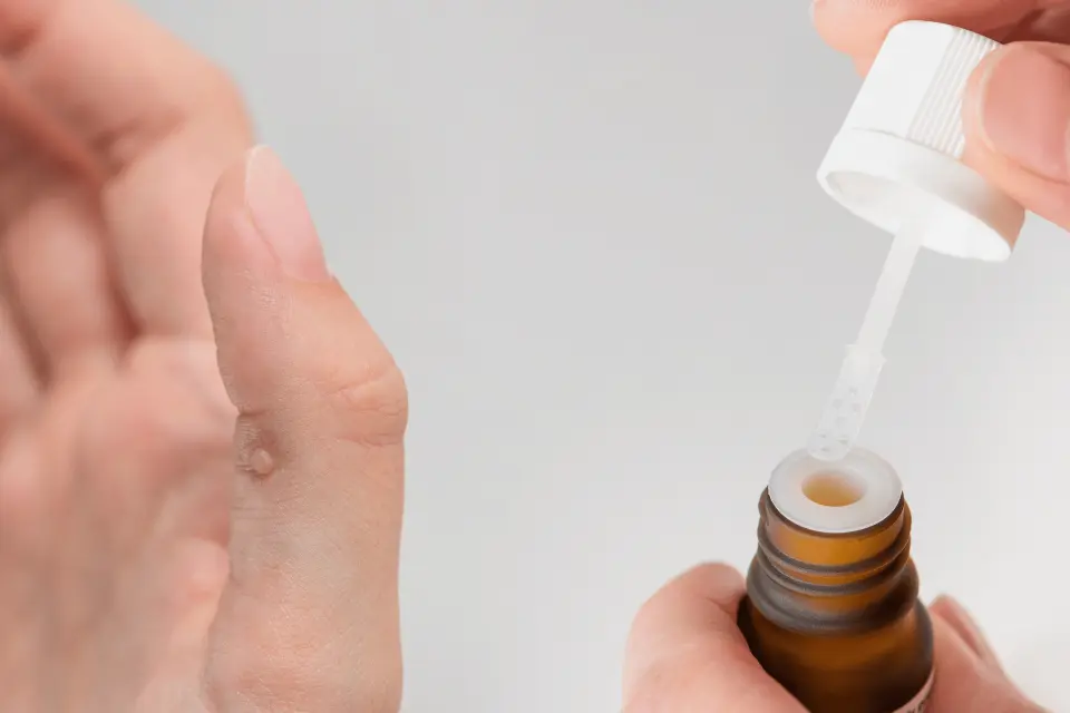 Warts on Hands: Causes, Treatment, and When They Need Medical Attention