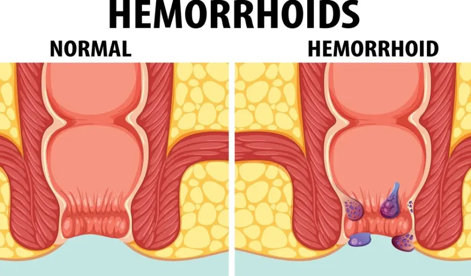 Normal Anus vs Hemorrhoids: What You Should Know (2026)