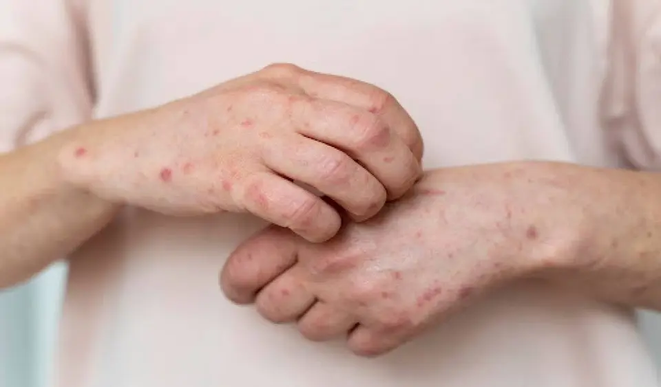 Folliculitis vs Herpes: What's Causing the Rash? (2026)