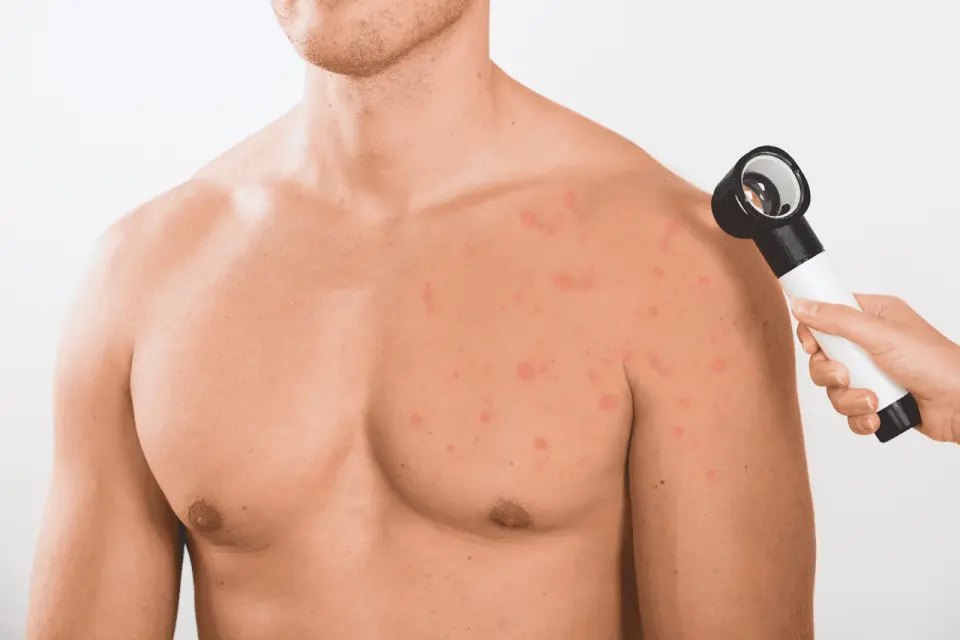 What Causes Chest Acne and How to Treat It