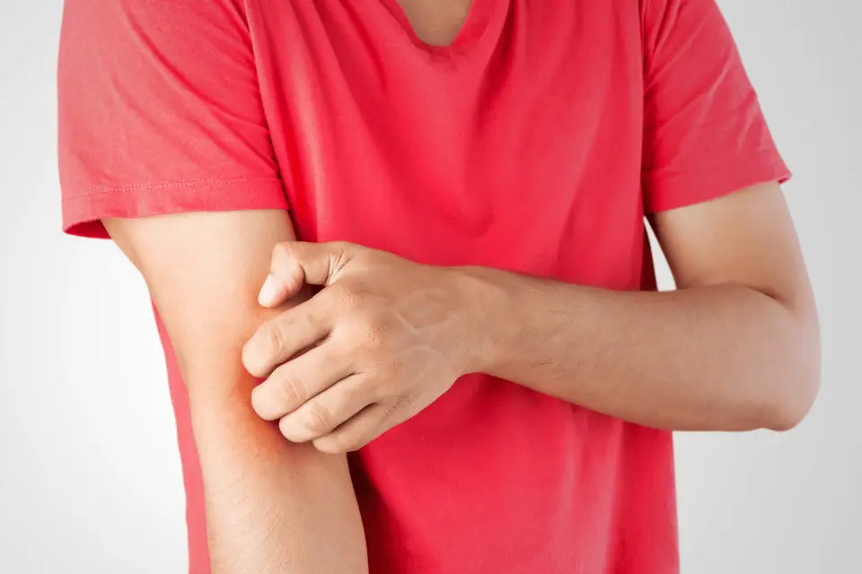 Is Eczema Contagious? What You Need to Know About Spread and Triggers