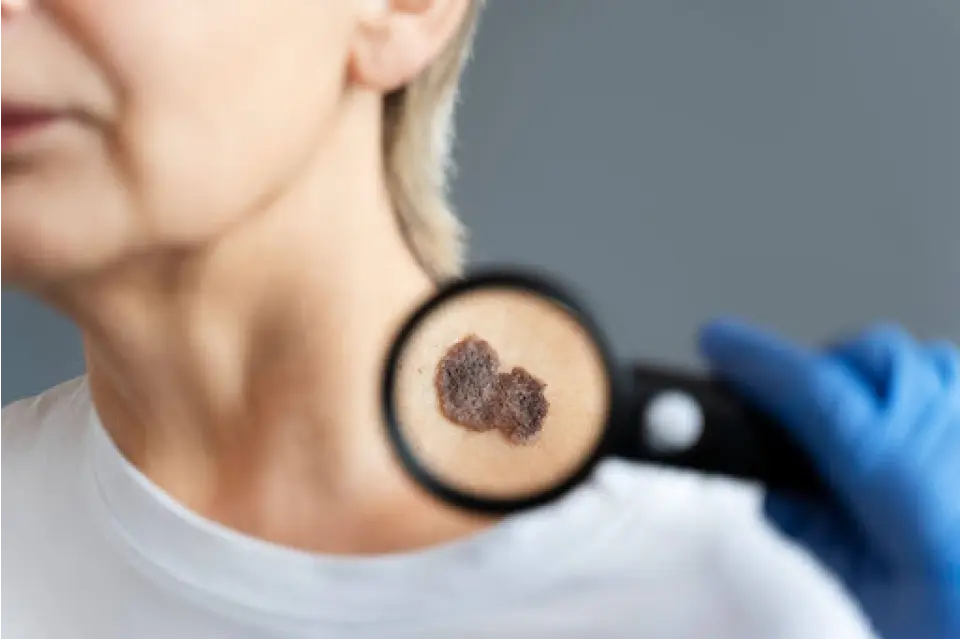 Seborrheic Keratosis vs Melanoma: Skin Spot Guide