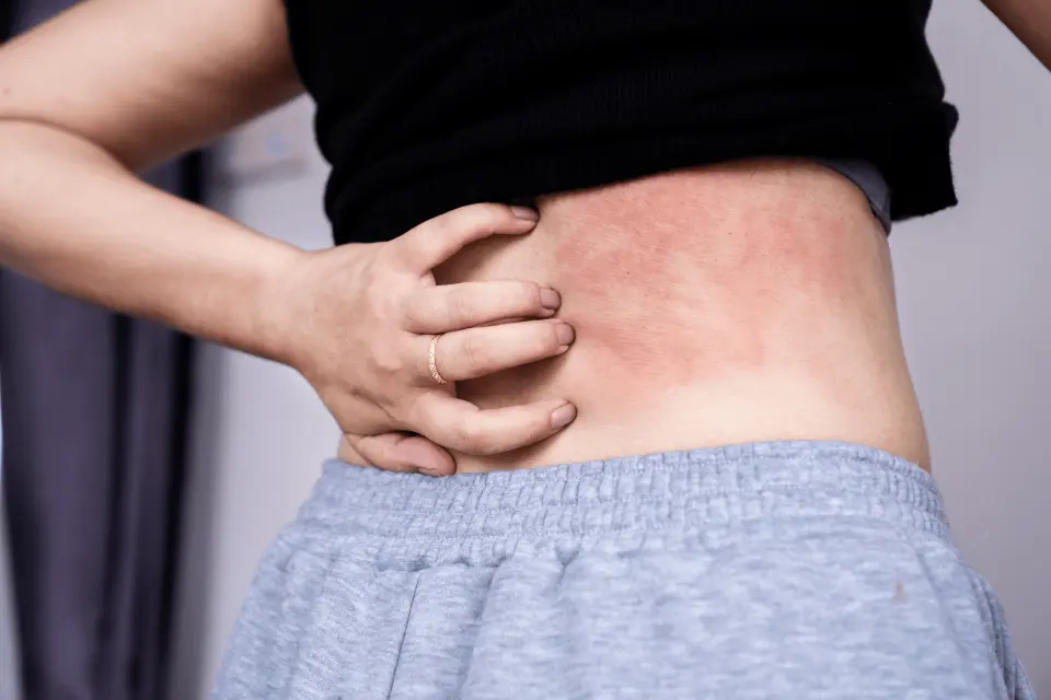 How to Treat Heat Rash: Quick Relief for Every Severity Level