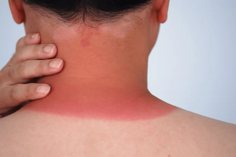 Sunburn Relief: Dermatologist-Approved Methods That Actually Work