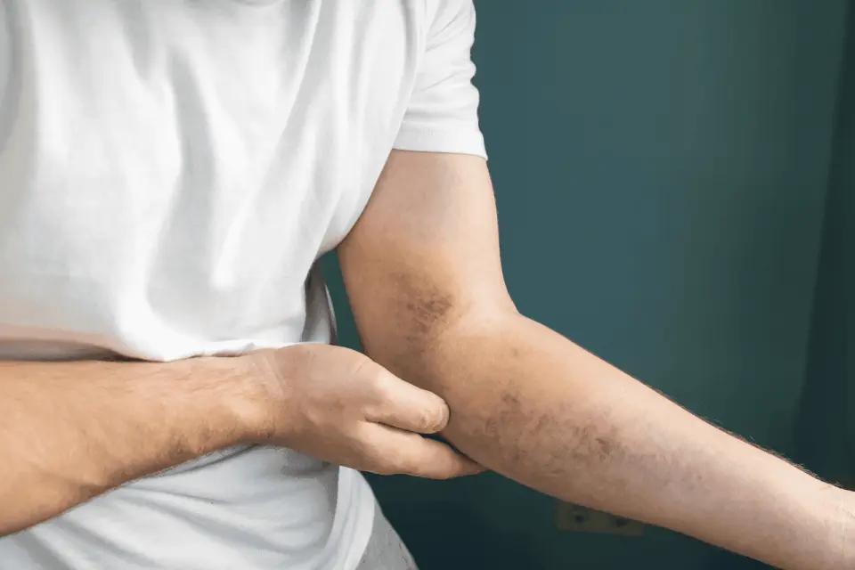 Bruising Too Easily? Here's What Your Body Might Be Telling You (2026)