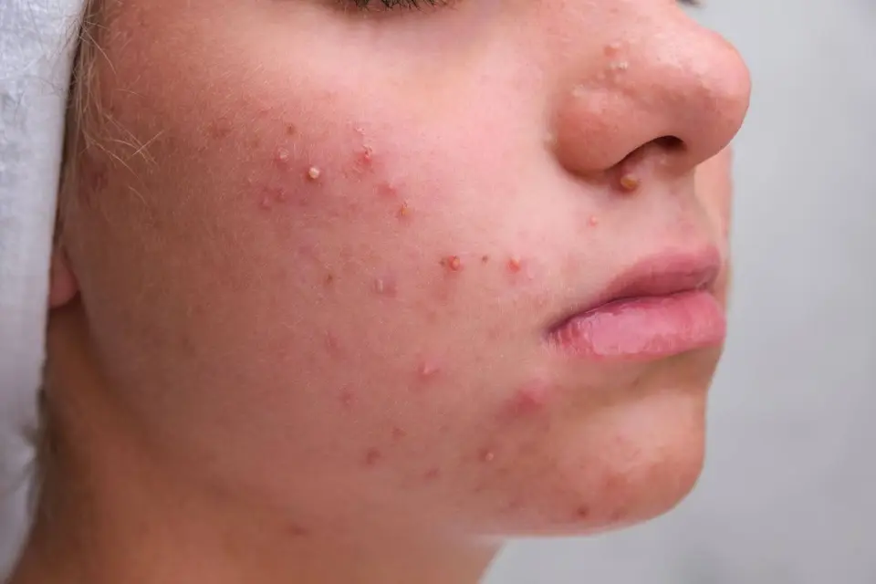can retatrutide cause acne The numbers from Lilly's Phase 3 trial dropped this week and I Retatrutide Side Effects: What Clinical