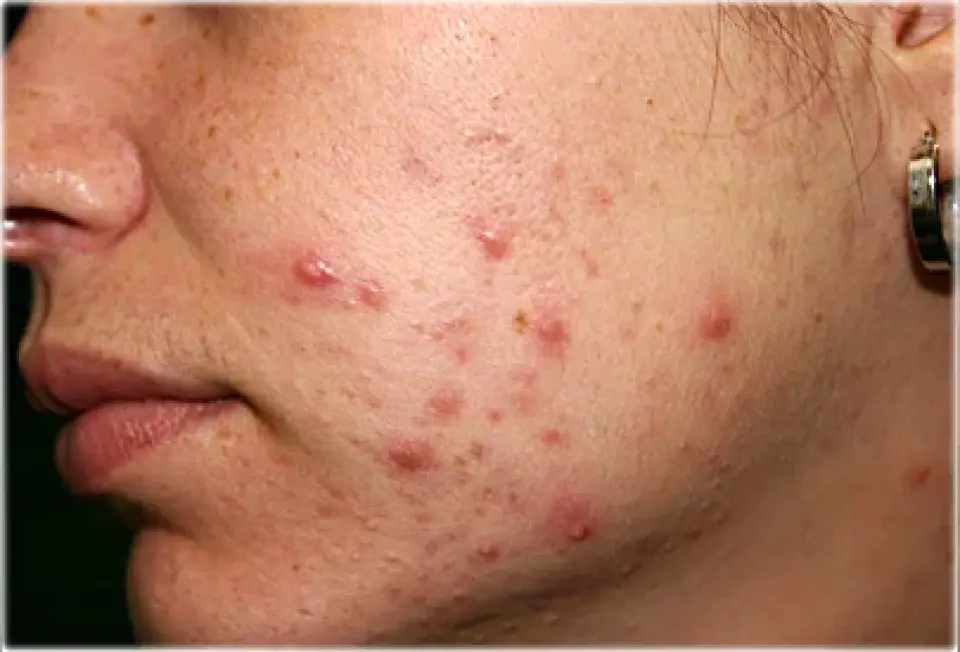 Cold Sore vs Pimple: Which One Is It?
