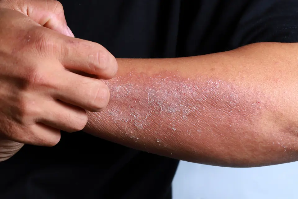 Pimecrolimus Cream Side Effects: 2026 Guide