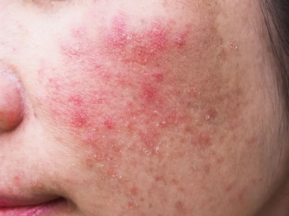 What Is Fungal Acne and How Can You Treat It?