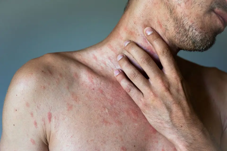 What Causes a Rash on the Stomach?