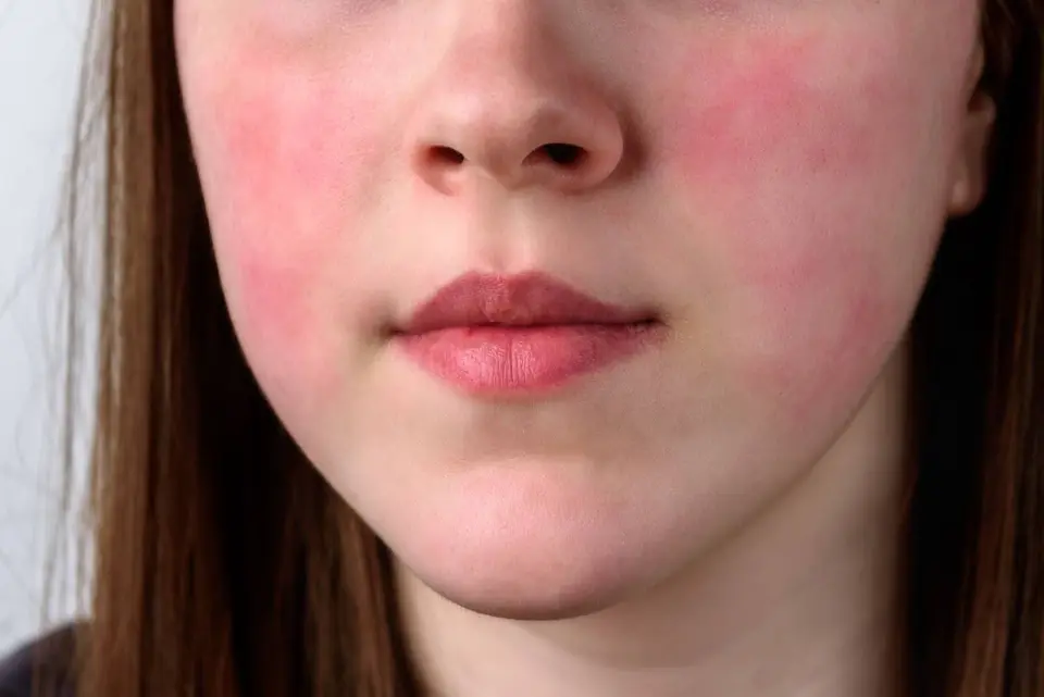 Lupus Rash vs Rosacea: Spotting the Key Differences