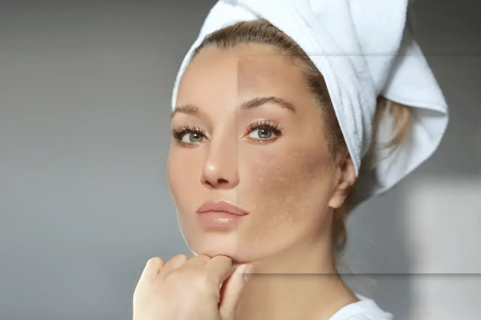 Melasma on Your Face: Why Sun Exposure Makes It Worse