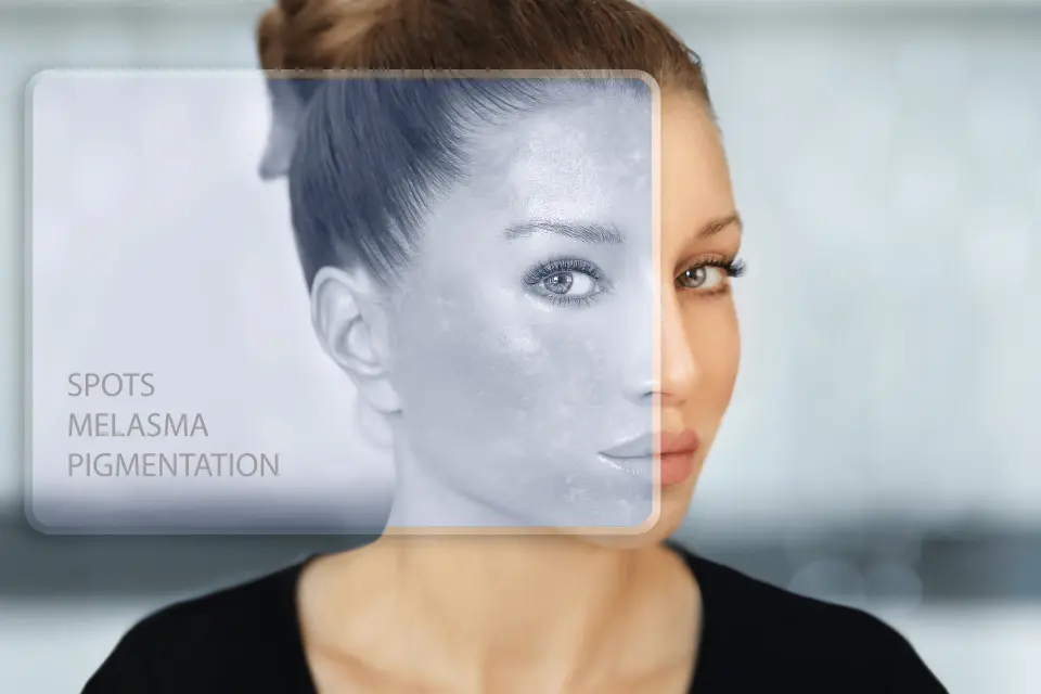 What Is Hyperpigmentation? A Complete Guide to Causes and Treatments