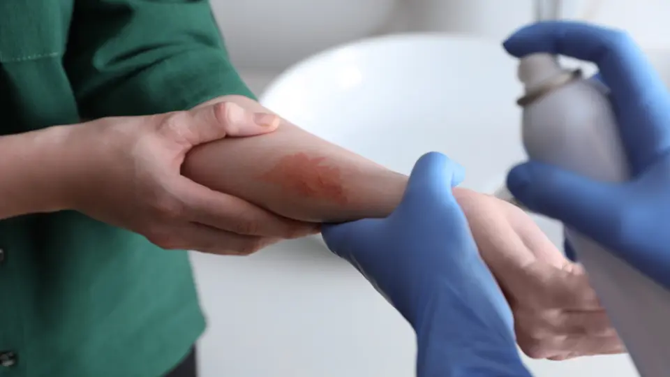 When Should You Go to Urgent Care for a Burn?