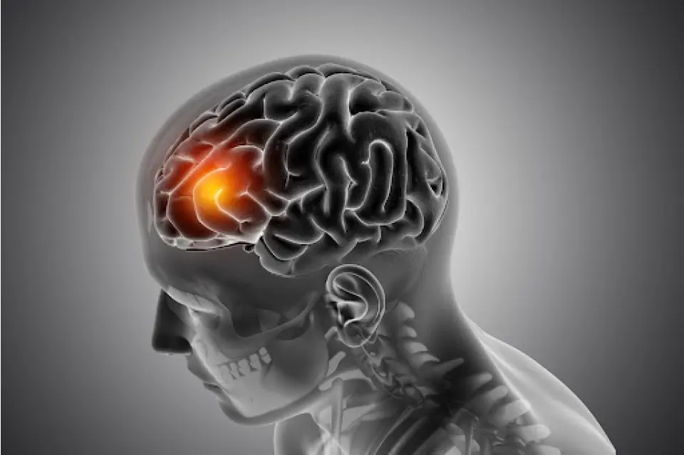 Stroke vs Heart Attack: Key Differences You Should Know