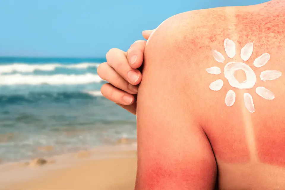 Sun Rash: Why Your Skin Reacts to Sunlight and How to Manage It