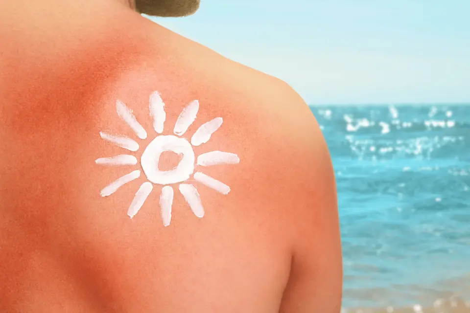 Sun Poisoning Rash: What It Looks Like and How to Treat It