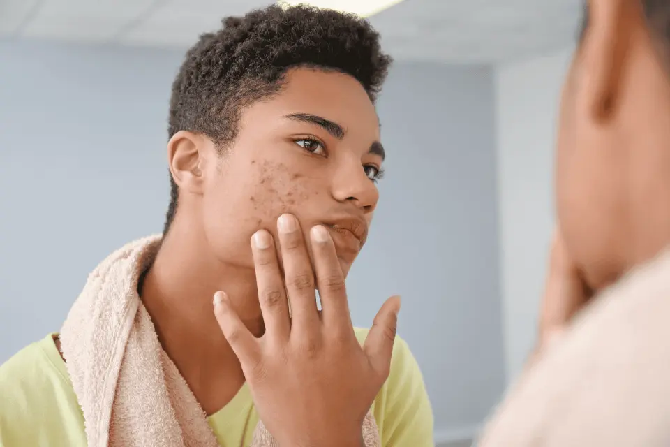 Can an AI Doctor Prescribe Acne Medication?