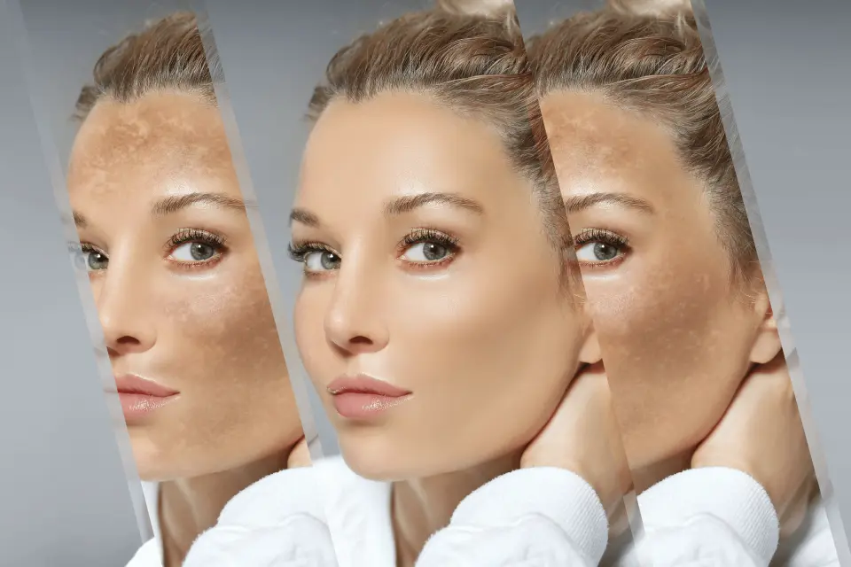 Melasma vs. Hyperpigmentation: Key Differences and Treatment Approaches