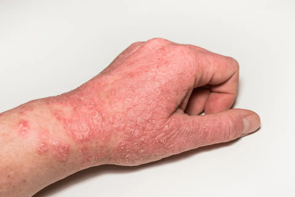 Can Urgent Care Treat Eczema?