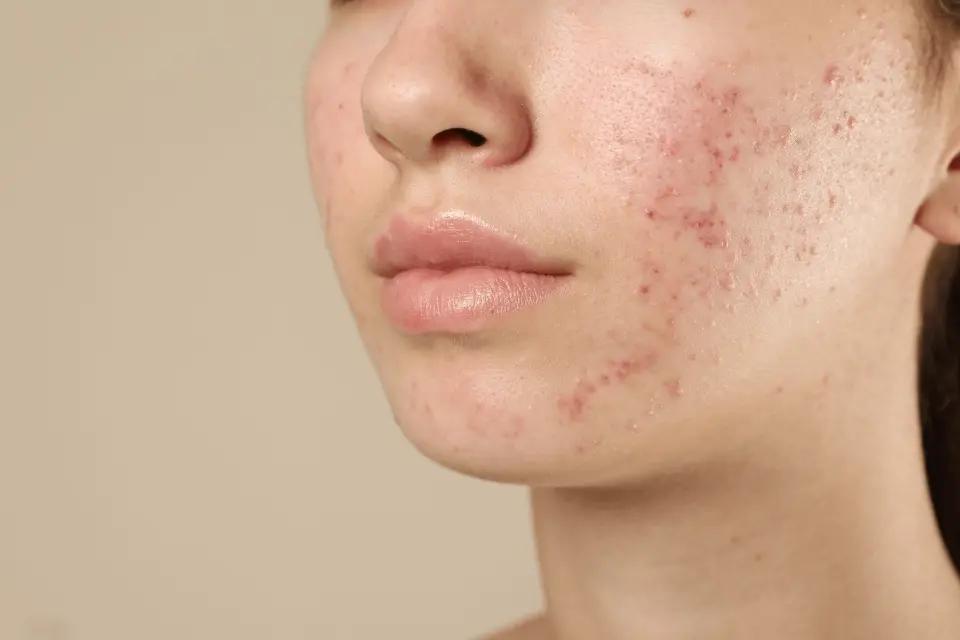7 Common and Serious Side Effects of Claravis