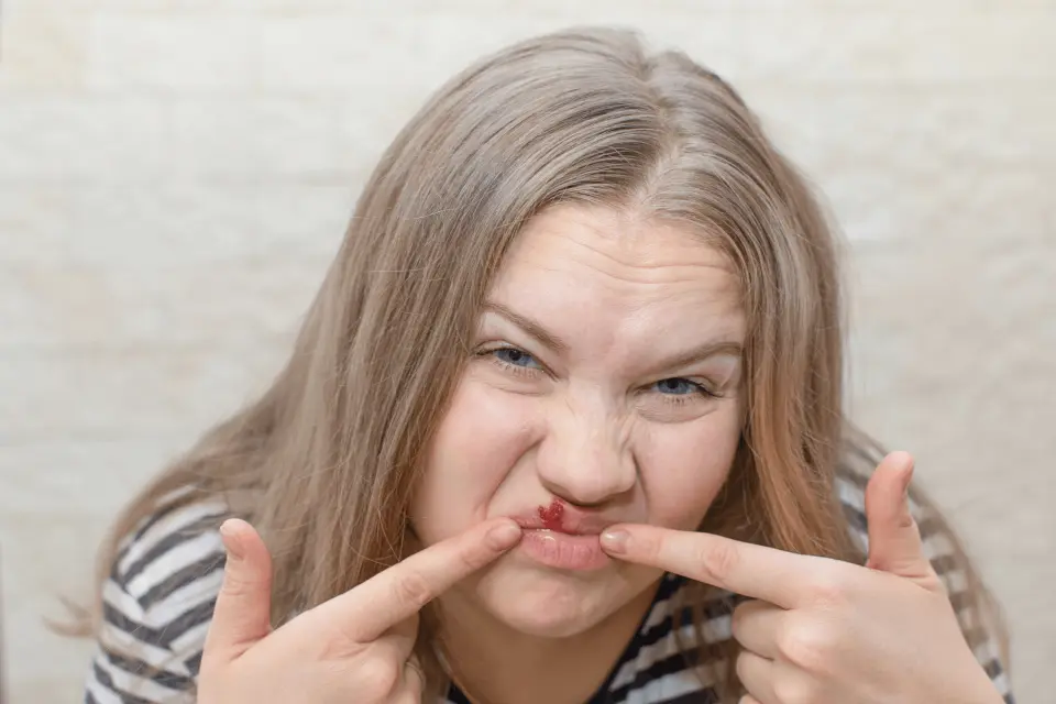 Are Cold Sores Contagious? Yes, Here’s What You Should Know