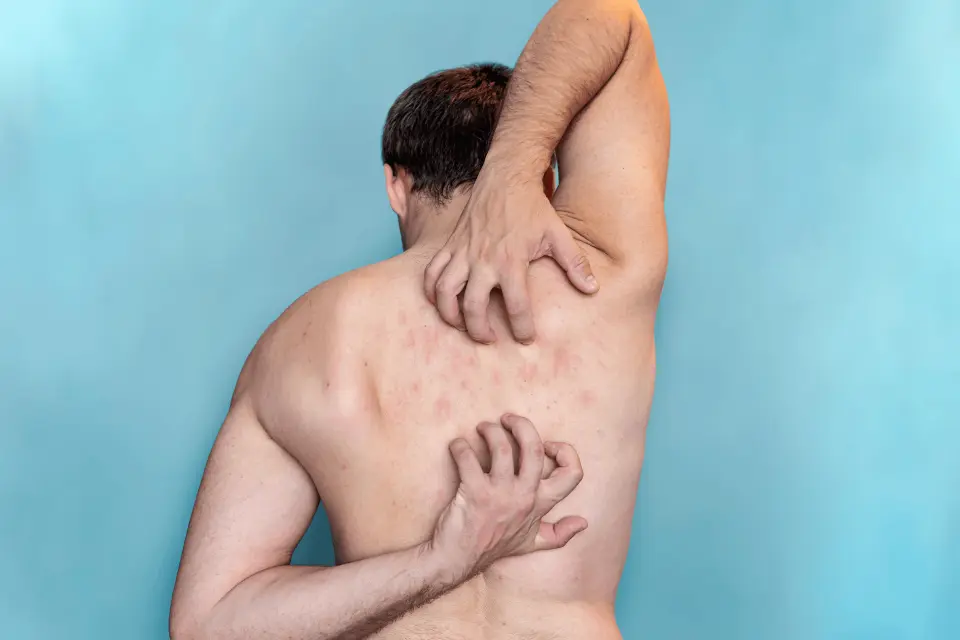 Eczema vs Scabies: How to Identify and Treat Each