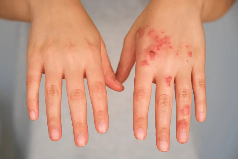 Hand Eczema: Causes, Symptoms, and Best Treatments