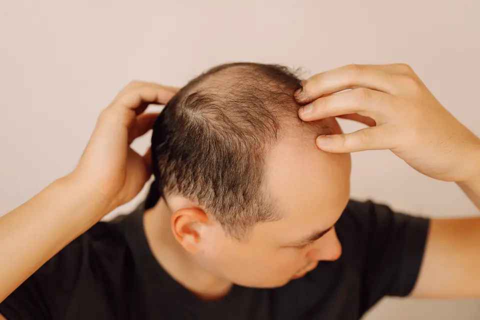 What Causes Hair Loss on the Crown of the Head?