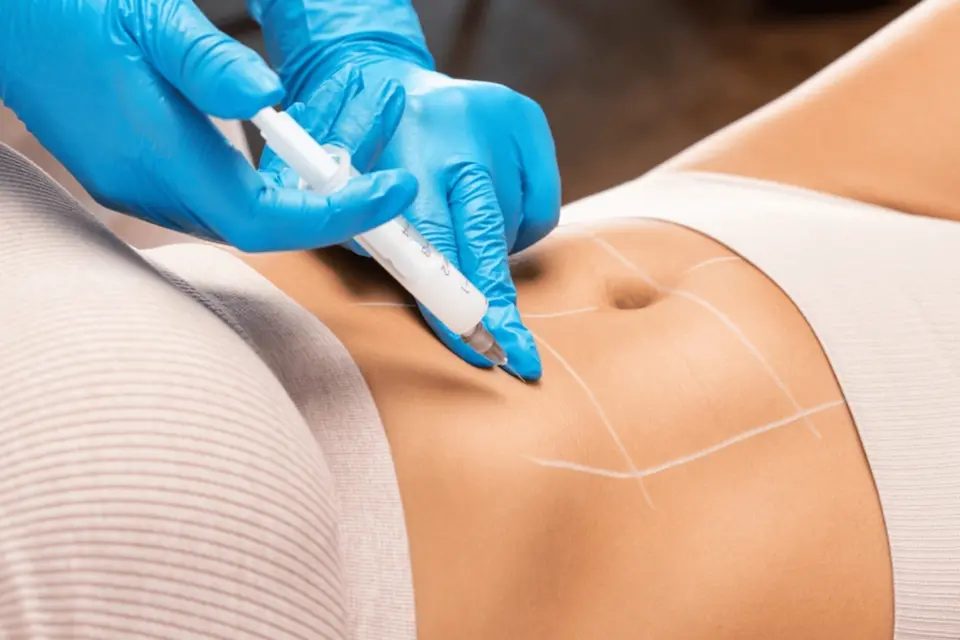 Where to Inject Ozempic: Injection Sites Explained
