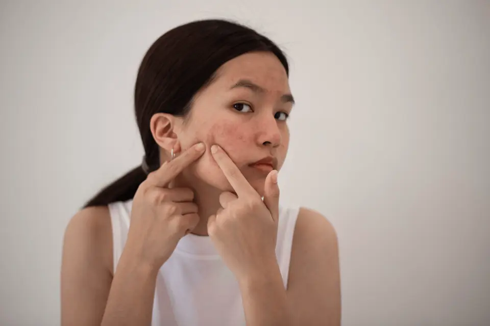 Can the Pill Cause Acne? Here’s the Truth