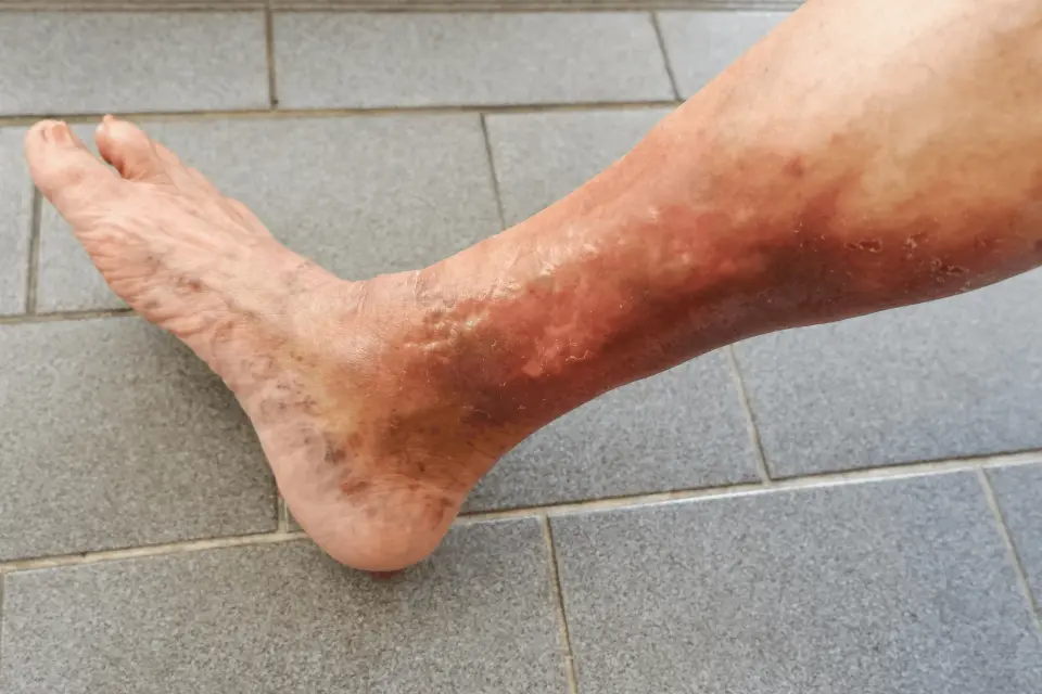 Stasis Dermatitis: Causes, Symptoms, and Treatment Options