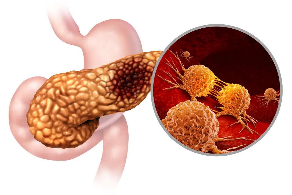Mounjaro and Pancreatitis - What to Know