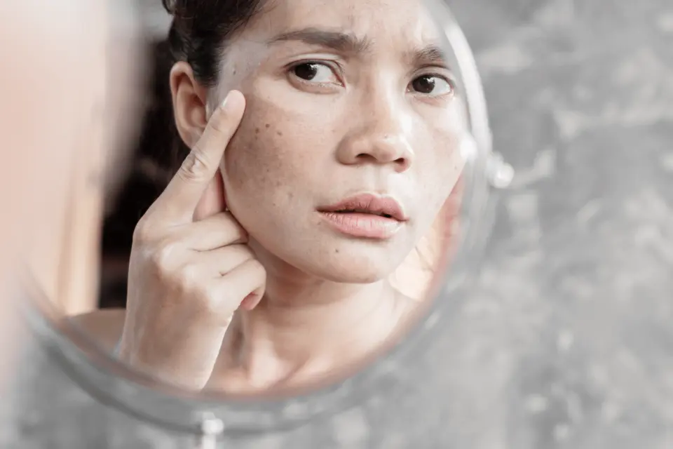 Best Sunblock for Melasma: How UV Protection Prevents Dark Patches