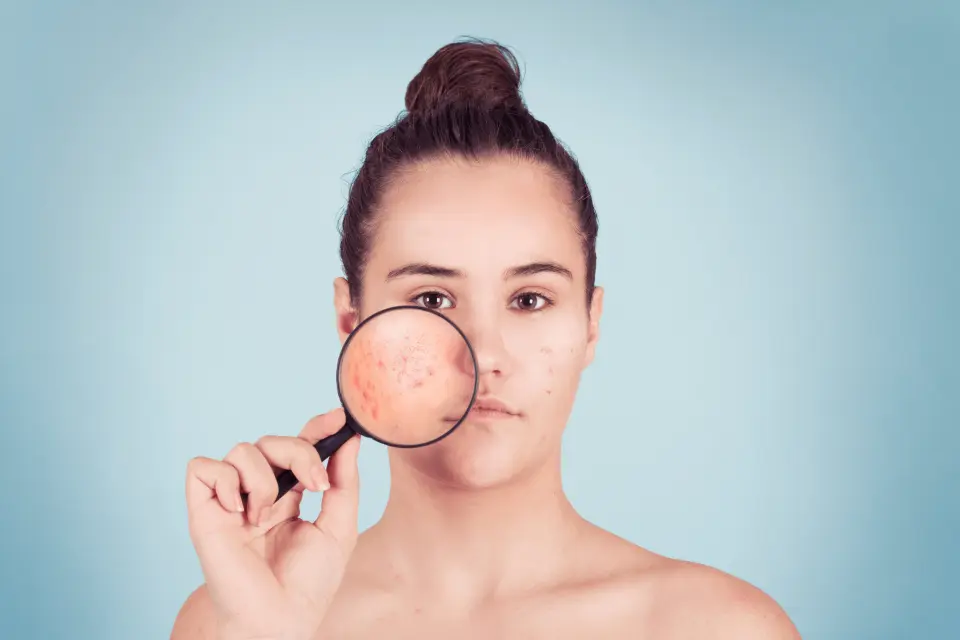 6 Common and Serious Side Effects of Retin-A
