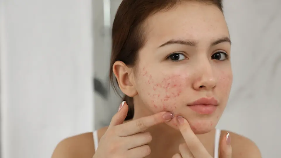 How to Fade Acne Scars Naturally in One Week