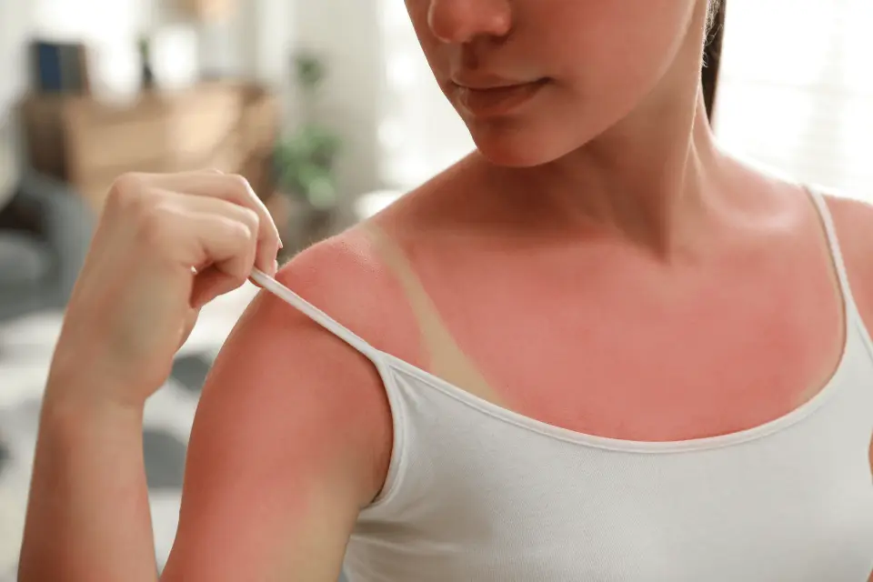 How to Treat Sun Poisoning at Home (and When to See a Doctor)