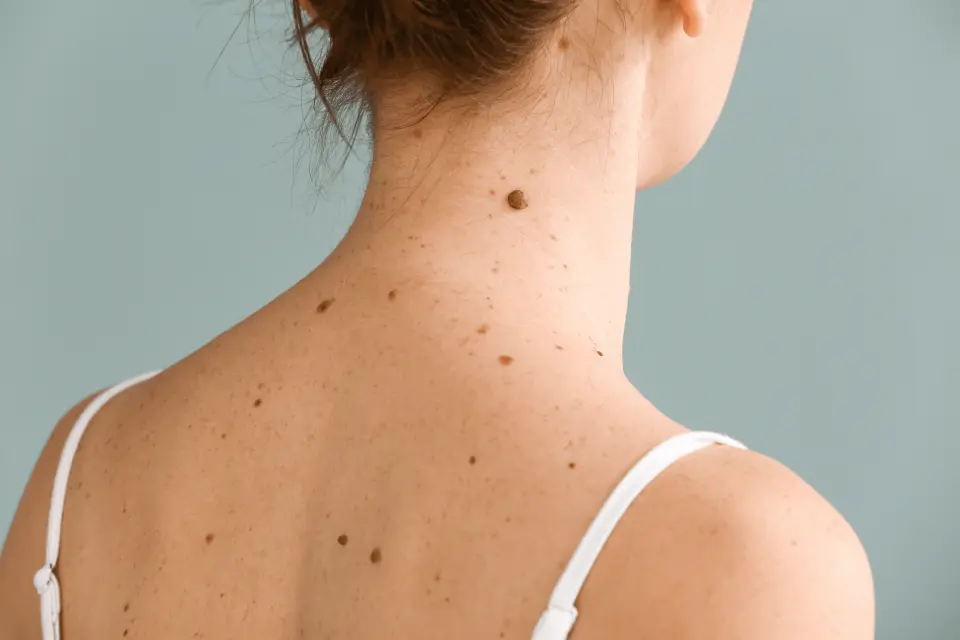 Cancerous Moles vs. Normal Moles: A Visual Guide to Melanoma Warning Signs