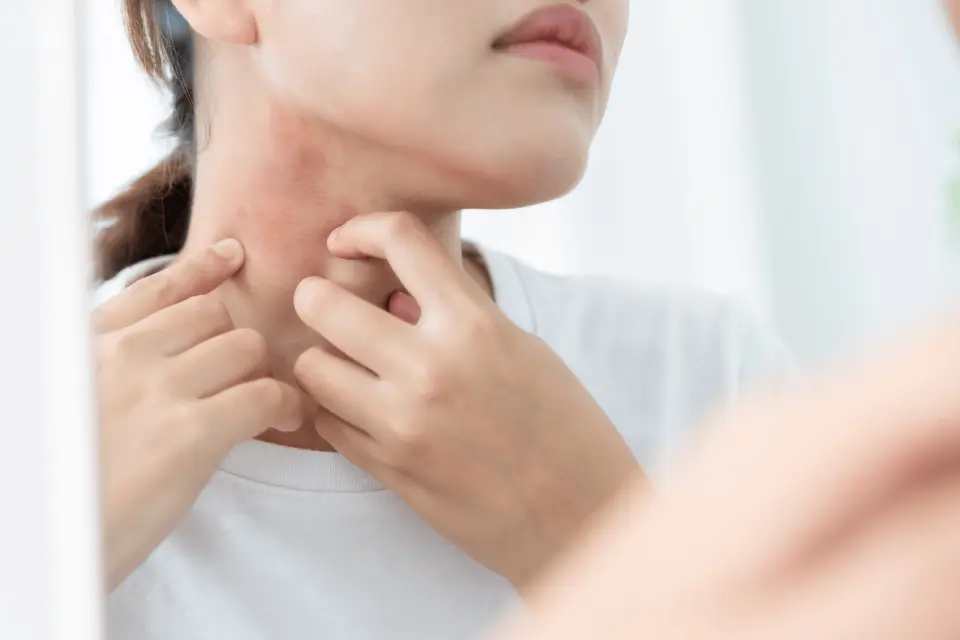 Heat Rash Treatment: Fast Relief for Prickly, Irritated Skin