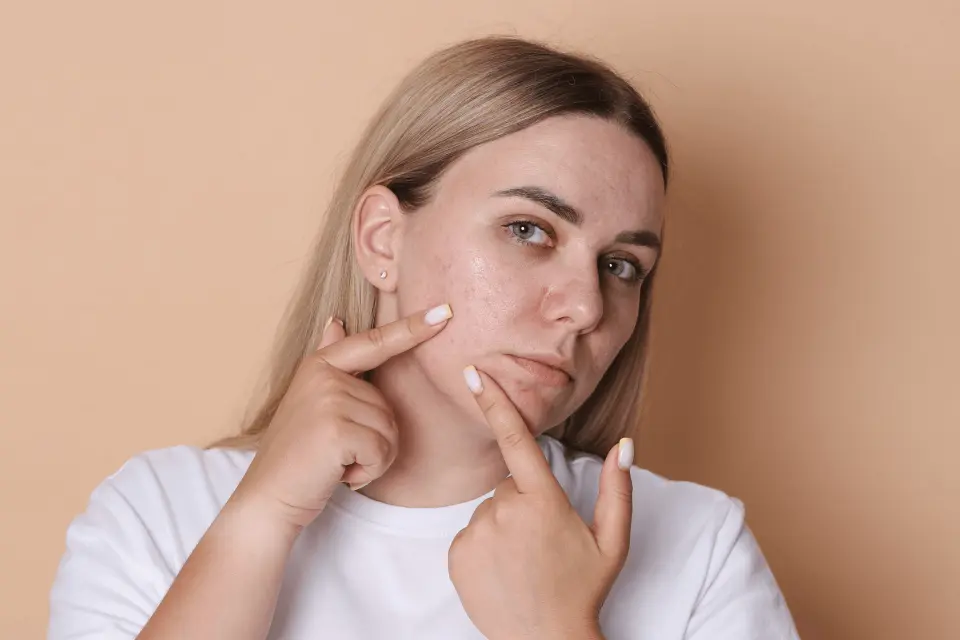 How to Get Rid of Acne Scars: Dermatologist-Recommended Treatments