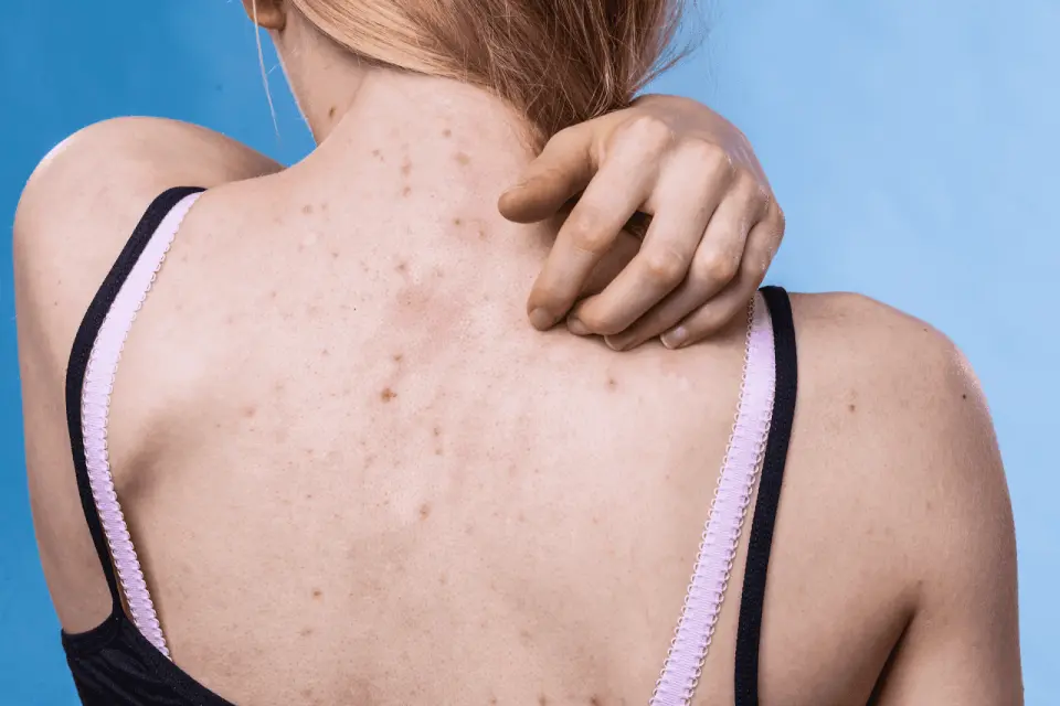 How to Clear Shoulder Acne for Good