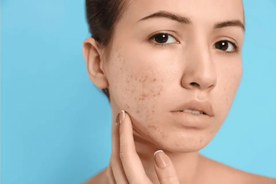 Natural Ways to Fade Acne Scars